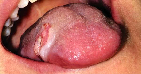 This intraoral clinical photograph shows a frontal view of the oral cavity, highlighting a significant lesion on the middle third of the right lateral border of the tongue. The lesion presents as a 2 cm exophytic, ulcerated mass with irregular, raised, and rolled everted borders—a classic presentation of squamous cell carcinoma. The central ulcerated portion displays a variegated appearance with areas of erythema (redness) and leukoplakia (white patches), suggesting infiltration into the underlying tongue musculature. While the lesion itself appears relatively well-demarcated from the surrounding healthy pink mucosa, it demonstrates aggressive morphology. Adjacent oral structures, including the lower lip and right buccal mucosa, show signs of maceration and leukoedema, likely secondary to a chronic habit such as cheek or lip biting. The visible dentition appears healthy and well-aligned. This image is an essential educational resource for identifying early to mid-stage oral malignancies and distinguishing them from benign oral ulcers based on clinical features like induration, size, and border morphology.