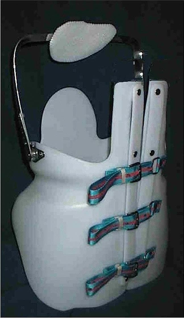 A studio photograph of a Maria Adelaide (MA) brace, a specialized rigid spinal orthosis used in the management of adolescent idiopathic scoliosis and Scheuermann’s kyphosis. The device is a univalve, custom-molded thoracolumbosacral orthosis (TLSO) constructed from white thermoplastic material. Key anatomical features include a posterior thoracic extension for sagittal plane control and a prominent, padded sternal plate supported by a thin metallic superstructure. The closure system consists of three horizontal, adjustable fabric straps in red and blue, secured with metallic buckles on the lateral-anterior aspect to facilitate precise tensioning and correction of spinal curves. The design emphasizes a 'low-profile' approach compared to traditional Milwaukee braces while maintaining corrective pressure at the sternum and spine. This image serves as a clinical reference for orthopedic surgeons, physiotherapists, and orthotists to understand the structural components and closure mechanisms of this specific orthopedic device.