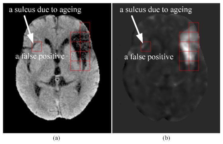 This educational image consists of two side-by-side axial brain CT slices (a and b) demonstrating the challenges of automated cerebral infarct detection in elderly patients. Figure (a) is a processed grayscale CT slice showing the brain parenchyma with visible age-related changes. A red square on the right hemisphere (anatomical left) highlights a deepened sulcus, labeled as a 'false positive' and 'a sulcus due to ageing.' The area appears as a dark, hypodense linear feature representing cerebrospinal fluid-filled spaces common in brain atrophy. Figure (b) displays the corresponding t-score map, where the same sulcular region is represented by high-intensity (bright white) pixels within a red square. This high t-score indicates a significant statistical deviation from a younger control group template, leading to an erroneous identification of an infarct. The image illustrates the clinical relevance of age-matched control groups in neuroradiological diagnostic algorithms to prevent false positives caused by normal age-related structural evolution such as cortical atrophy and sulcal widening.