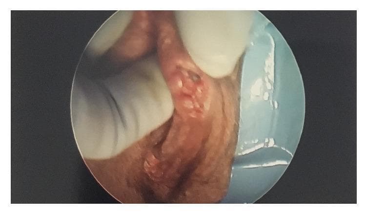 Clinical photograph of a vulvar mass, specifically ectopic mammary gland-like tissue (EMGLT), captured during a surgical procedure. The image depicts a 2 cm irregular, nodular mass located on the right vulva at the labia minora juncture. The lesion exhibits a pinkish-red, erythematous color with a rough, multinodular surface texture. Some areas show pale protrusions and signs of recent biopsy instrumentation. The surrounding vulvar skin appears tanned and more regular in texture compared to the focal pathology. A gloved hand is visible at the top and left, retracting the tissue for visualization, while blue surgical draping is seen in the background. This image serves to illustrate the clinical appearance of accessory breast tissue located along the embryonic milk line, demonstrating why it may be mistaken for other vulvar neoplasms like Bartholin gland cysts or hidradenoma papilliferum.