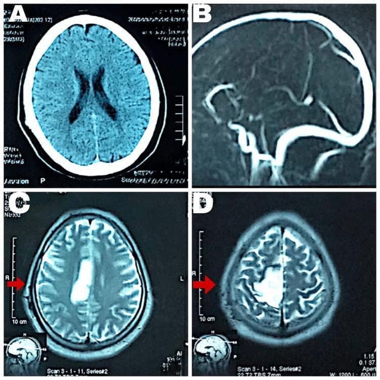 This composite of diagnostic neuroimaging displays a comparison between CT and MRI findings in a case of cerebral infarction. Panel A shows an axial non-contrast CT scan of the brain with no acute intracranial abnormalities visible. Panel B is a sagittal magnetic resonance venography (MRV) showing major venous sinuses. Panels C and D are axial MRI Fluid-Attenuated Inversion Recovery (FLAIR) sequences at different superior levels. These FLAIR images reveal a hyperintense, well-demarcated lesion in the right parietal region, specifically within the vascular territory of the anterior cerebral artery (ACA). Red arrows highlight this area of high signal intensity, which is characteristic of an acute to subacute ischemic infarct. The imaging demonstrates the superior sensitivity of MRI FLAIR sequences over standard CT for detecting early ischemic changes and edema. This resource is suitable for medical education regarding stroke localization, neuroimaging modalities, and the radiographic appearance of vascular insults in the brain.