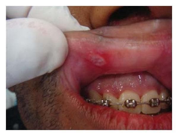 This clinical photograph provides an intraoral view of a minor Recurrent Aphthous Ulcer (RAU) located on the labial mucosa of the upper right side lip. The lesion is a solitary, shallow, ovoid ulcer approximately 5mm in diameter, characterized by a necrotic pseudomembranous center with a whitish-yellow hue. It is demarcated by a prominent, well-defined erythematous halo, indicating active inflammation. The surrounding oral mucosa appears mildly hyperemic. Visible anatomical structures include the maxillary gingiva and teeth, with fixed orthodontic appliances (braces) present. In the clinical context of an immunocompromised patient (HIV+), such lesions are significant as they may represent a manifestation of decreased immune surveillance and can severely impact quality of life due to associated pain and dysphagia. The image demonstrates classic morphological features used in the diagnosis of minor aphthous stomatitis, distinguishing it from major or herpetiform variants.