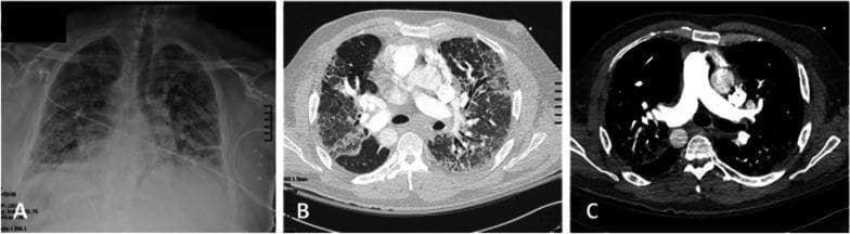 This set of diagnostic images includes a chest X-ray (A) and axial computed tomography (CT) scans (B and C) demonstrating the findings of Kartagener syndrome. In image A, a posteroanterior chest radiograph reveals dextrocardia (heart apex pointing to the right) and diffuse, bilateral reticulonodular opacities consistent with chronic interstitial lung disease. Image B is a CT lung window showing extensive bilateral bronchiectasis, thickened bronchial walls, and cystic changes, characteristic of advanced suppurative lung disease. Image C is a contrast-enhanced CT mediastinal window clearly illustrating situs inversus totalis, with the heart and great vessels positioned as a mirror image of normal anatomy (dextrocardia with the aortic arch on the right). These images highlight the cardinal features of primary ciliary dyskinesia: situs inversus and severe bronchiectasis, providing critical pre-operative context for patients requiring advanced interventions such as lung transplantation.