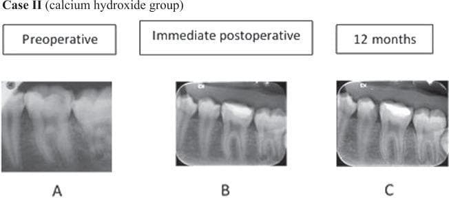 This set of diagnostic images consists of three periapical radiographs showing the longitudinal progression of a mandibular molar treatment within a dental pulp capping study (Calcium Hydroxide group). Panel A (Preoperative) reveals a deep occlusal radiolucency consistent with dental caries extending toward the pulp chamber of the first molar. Panel B (Immediate postoperative) shows the molar following indirect pulp capping and restoration with a radiopaque restorative material; a thin layer of therapeutic material (calcium hydroxide) is positioned over the pulp floor. Panel C (12 months follow-up) demonstrates the long-term clinical outcome, characterized by the formation of a distinct radiopaque bridge of reparative dentin beneath the restoration, effectively increasing the thickness of the dentin barrier between the restoration and the pulp chamber. The periapical region remains healthy with no signs of apical periodontitis or inflammatory bone resorption throughout the 12-month period. This comparison illustrates successful pulp preservation and the biological response of dentin-pulp complex regeneration.
