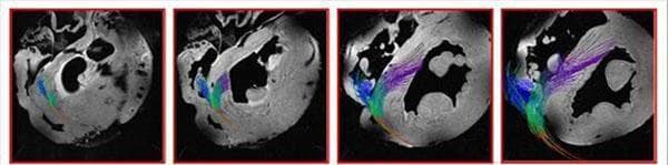 This diagnostic imaging series consists of four sequential high-resolution MR microscopy frames demonstrating cardiac fiber tracking of the conduction system. The images provide a 3D visualization of the specialized conduction pathways from the base of the heart toward the midwall. The tracking originates behind the non-coronary leaflet at the cardiac base. Color-coded diffusion tensor imaging (DTI) or similar fiber tractography techniques are utilized to differentiate pathways: blue fibers represent the bundle proceeding down the right ventricular subendocardium, while purple fibers illustrate the branch traversing the interventricular septum before descending into the left ventricular subendocardium. As the sequence progresses from frame A to D, the left ventricular branch expands into a fan-like structure, ultimately terminating in free-running Purkinje fibers within the ventricular cavity. This visual highlights the micro-anatomical orientation of the His-Purkinje system, essential for understanding ventricular depolarization and electrical signaling in cardiac physiology.