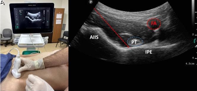 This composite educational image illustrates the Pericapsular Nerve Group (PENG) block, a regional anesthesia technique for hip analgesia. Panel A shows the clinical setup, including the patient’s supine position and the transverse orientation of a curved-array ultrasound probe at the level of the inguinal crease. Panel B presents the corresponding sonographic anatomy. Key landmarks include the hyperechoic bony contours of the anterior inferior iliac spine (AIIS) and the iliopubic eminence (IPE). The psoas tendon (PT) is identified as a hypoechoic oval structure resting between these bony prominences. The femoral artery (FA) is visualized medially as an anechoic, pulsatile vessel. A dashed red arrow demonstrates the in-plane needle trajectory, targeting the fascial plane between the psoas tendon and the pubic ramus. This block specifically targets the articular branches of the femoral nerve, obturator nerve, and accessory obturator nerve to provide sensory blockade of the anterior hip capsule without significant motor impairment.