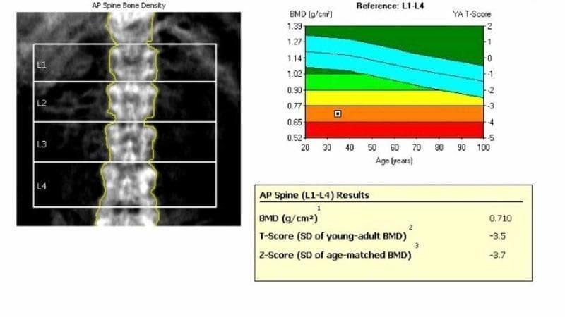 This diagnostic report displays a dual-energy X-ray absorptiometry (DEXA) scan of the lumbar spine (L1-L4) and its corresponding analytical data. The visual includes an anteroposterior (AP) bone mineral density (BMD) image showing the vertebral bodies L1 through L4, each segmented by rectangular regions of interest for quantitative analysis. To the right, a reference graph plots the patient's BMD (0.710 g/cm²) against age-matched and young-adult (YA) population norms. The graph features color-coded zones: green for normal, yellow for osteopenia, and orange/red for osteoporosis. The patient's data point is notably positioned in the orange zone, indicating significantly reduced bone density. Below the graph, a results table summarizes the findings: a BMD of 0.710 g/cm², a T-score of -3.5 (standard deviations below the YA mean), and a Z-score of -3.7 (standard deviations below the age-matched mean). These findings are clinically indicative of severe osteoporosis or metabolic bone diseases such as osteomalacia, highlighting a high risk for insufficiency and compression fractures.