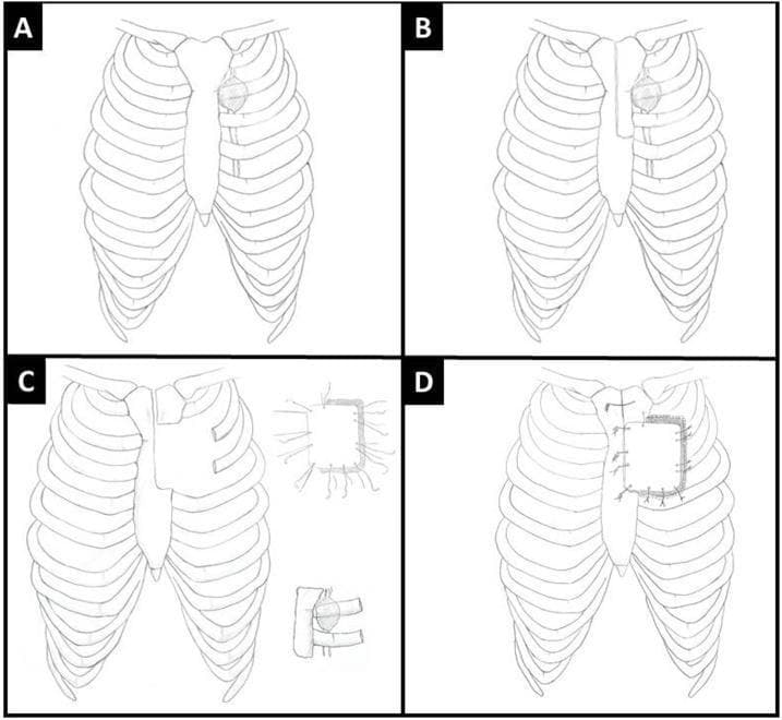 A four-panel (A-D) anatomical diagram illustrating radical en bloc resection and reconstruction of a chest wall defect following metastasis to the internal mammary lymph node (IMLN). Panel A shows the thoracic cage with a solitary metastatic IMLN located in the left parasternal region near the second and third ribs. Panel B depicts the surgical defect resulting from the resection of a portion of the manubrium, hemi-sternum, and the medial aspects of the second and third ribs. Panel C demonstrates the preparation of a methyl methacrylate (MMS) marlex mesh plate, showing the prosthesis alongside a detail of the radiating Prolene sutures used for anchoring. Panel D illustrates the final thoracic wall reconstruction, where the MMS plate is secured to the remaining sternum with wires and the peripheral mesh is sutured to the adjacent ribs and soft tissues to restore chest wall integrity. This illustration serves as an educational guide for thoracic surgeons regarding complex anterior chest wall resection and prosthetic reconstruction techniques.