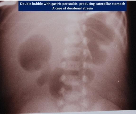 This abdominal X-ray of a neonate demonstrates the classic 'double bubble' sign, highly indicative of duodenal atresia. Two large, air-filled radiolucencies are visible in the upper abdomen: a larger gastric bubble on the patient's left and a smaller duodenal bubble on the right of the midline. A notable feature in this specific image is the 'caterpillar sign,' where the dilated gastric wall shows multiple waves of peristalsis (undulating borders), suggesting an attempt by the stomach to overcome the distal obstruction. There is a complete absence of bowel gas distal to the duodenum throughout the rest of the abdomen, signifying high intestinal obstruction. This diagnostic image is a key educational resource for pediatric radiology and neonatal surgery, illustrating the pathophysiology of congenital intestinal malformations and the radiographic markers used to differentiate them from other causes of neonatal emesis.