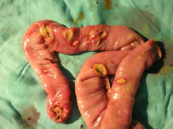 This clinical photograph shows a surgical specimen of the distal ileum placed on a green surgical drape. The anatomical structure exhibits multiple typhoid-related intestinal perforations. The ileal wall is predominantly pinkish-red, appearing moist and edematous. Approximately six to seven distinct perforations are visible, ranging in morphology from small pinholes to larger, irregular ovoid defects. The edges of these perforations are ragged and hyperemic, suggesting significant transmural inflammation. Yellowish slough or intestinal contents are visible within and surrounding several of the holes, indicative of leakage and associated peritonitis. This image illustrates a severe complication of enteric fever (Typhoid fever), specifically Peyer's patch necrosis leading to multiple intestinal perforations, which typically occur within 30 cm of the ileocecal valve. It serves as an educational reference for surgical pathology and complications of infectious gastrointestinal diseases.