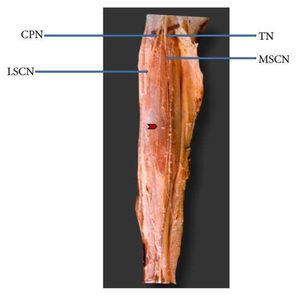 This clinical anatomical photograph displays a cadaveric dissection of the posterior lower leg, specifically focusing on the branching patterns of the nerves in the popliteal fossa and posterior calf. The image illustrates the division of the sciatic nerve into the tibial nerve (TN) and common peroneal nerve (CPN). From the tibial nerve, the medial sural cutaneous nerve (MSCN) is seen descending vertically. The lateral sural cutaneous nerve (LSCN) is labeled as a branch of the CPN. A significant anatomical variation is highlighted by a red arrowhead: an additional accessory branch originating from the common peroneal nerve superior to the origin of the LSCN. This branch follows a descending longitudinal course but remains independent, showing no communication or anastomosis with the medial sural cutaneous nerve. This image serves as an educational resource for studying peripheral nerve anatomy and the morphological variations of the sural nerve complex, which is clinically relevant for nerve grafts, biopsies, and understanding compression neuropathies.