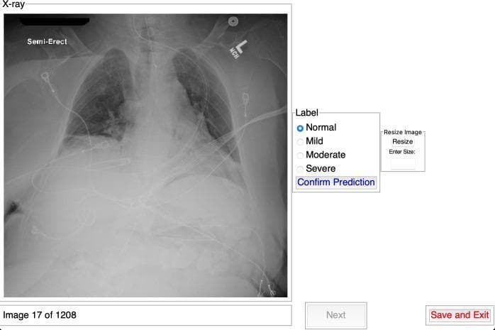 This diagnostic image illustrates a specialized medical data labeling interface designed for chest X-ray (CXR) classification. On the left, a semi-erect anteroposterior chest radiograph is displayed, showing a patient with visible medical support leads and tubing. The radiograph demonstrates diffuse bilateral lung opacities, commonly associated with conditions like COVID-19 pneumonia or pulmonary edema. The labeling panel on the right provides clinical severity classification options: Normal, Mild, Moderate, and Severe, with 'Normal' currently selected via a radio button. The interface includes interactive elements such as 'Confirm Prediction', an image resizing tool, and navigation controls ('Next', 'Save and Exit'). This platform is intended for medical education and research to establish ground truth datasets by capturing specialist interpretations of disease severity. Key concepts shown include thoracic radiology, disease severity grading, and the development of clinical decision support systems.