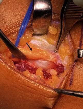 An intraoperative clinical photograph showing a surgical decompression of the common peroneal nerve (CPN) at the level of the fibular head. The central focus is the peroneal nerve, identified by a black arrow, which appears as a yellowish-tan, elongated structure. The nerve is visibly compressed and displaced by an underlying bony prominence, later identified as an osteochondroma. The nerve shows signs of adhesion and is seen being arched over by the fibers of the peroneus longus muscle. The surgical field includes various instruments, such as retractors and forceps, maintaining the exposure of the anatomical region. Surrounding the nerve, the tissue consists of lobular, yellow subcutaneous fat and reddish, striated skeletal muscle showing normal vascularization alongside some areas of surgical bruising. This image demonstrates the clinical presentation of peripheral nerve entrapment syndrome caused by an osteogenic tumor, illustrating the physical compression and the necessary surgical approach for decompression and neurolysis.