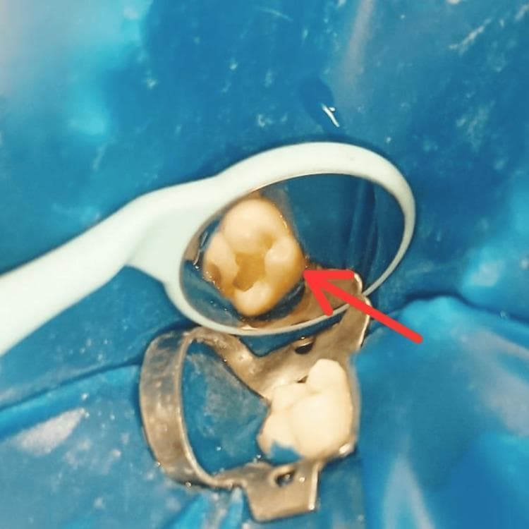 This intraoral clinical photograph demonstrates the procedural stages of operative dentistry, specifically caries excavation and cavity preparation on a mandibular molar. The field is isolated using a blue rubber dam secured with a metal clamp at the cervical margin of the tooth to ensure moisture control and a sterile working environment. In the upper portion of the frame, a dental mirror provides a reflective view of the occlusal surface, where a Class I cavity preparation is visible. A red arrow points to the prepared cavity, which shows well-defined margins and a clean pulpal floor following the removal of decayed tissue. The exposed dentin within the preparation exhibits a slightly darker hue compared to the surrounding peripheral enamel. This image serves as an educational example of standard protocols for conservative dental restoration, highlighting proper isolation and the morphological characteristics of a prepared tooth prior to composite resin application.