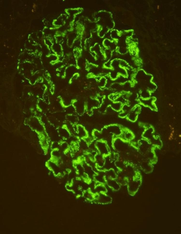 This diagnostic image is a high-power (400x) immunofluorescence micrograph of a human glomerulus from a renal biopsy specimen. The image demonstrates a diffuse, granular staining pattern of 3+ intensity, specifically localized along the glomerular capillary loops. The green fluorescent signal highlights the convoluted, interconnected morphology of the basement membrane area in a 'beaded' fashion, which is characteristic of immune complex deposition. Pathologically, this visual finding represents positive staining for phospholipase A2 receptor (PLA2R) antibodies, a definitive diagnostic marker for primary membranous nephropathy. The absence of mesangial or endocapillary staining emphasizes the subepithelial nature of the deposits. This specimen is critical for differentiating primary autoimmune-mediated glomerular disease from secondary causes in patients presenting with nephrotic syndrome.