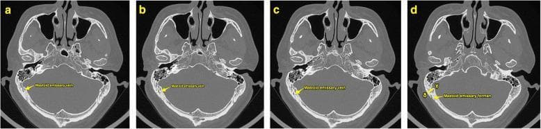 This diagnostic image consists of a series of four high-resolution axial computerized tomography (CT) scans (labeled a–d) of the human skull base, displayed in a bone window. The sequence demonstrates the surgical anatomy of the temporal bone, specifically highlighting the mastoid emissary vein (MEV) and its associated bony canal. In images a, b, and c, yellow arrows trace the course of the mastoid emissary vein as it traverses the mastoid part of the temporal bone. Image d, designated as 'Slice B', identifies the mastoid emissary foramen on the outer cortex. Key landmarks visible across all slices include the petrous and squamous parts of the temporal bone, the mastoid air cells, the sphenoid bone with the sella turcica, and the occipital bone. Annotations in frame d use Greek letters gamma (γ) and delta (δ) to indicate specific measurement points on the inner and outer cortical surfaces, respectively. This visual serves as an anatomical guide for preoperative planning in retrosigmoid approaches to the posterior cranial fossa, helping to avoid intraoperative hemorrhage from emissary veins.