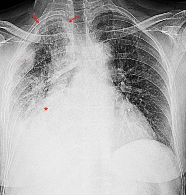 This frontal (posteroanterior) chest radiograph displays significant unilateral pathology of the right hemithorax in a 74-year-old male with a history of occupational asbestos exposure. Primary findings include a large right-sided pleural effusion causing basal opacification and obscuration of the right hemidiaphragm. Adjacent to the effusion, there is consolidation of the lung parenchyma, marked with an asterisk (*). Diffuse, irregular pleural thickening is evident along the right chest wall and apical regions (indicated by red arrows), accompanied by nodular pleural opacities (circled in red). Secondary features include notable right lung volume loss, resulting in a narrowed hemithorax and an ipsilateral shift of the mediastinum towards the right side. In contrast, the left lung appears relatively clear with preserved volume. These radiographic signs are highly suggestive of malignant pleural mesothelioma or advanced pleural disease related to asbestos exposure. This image serves as a clinical example for medical students and residents in radiology and pulmonology to identify signs of pleural malignancy and volume-contracting thoracic processes.