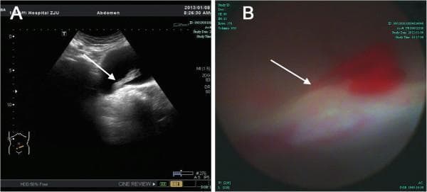 This composite image illustrates diagnostic findings in a patient with gross hematuria, categorized under Urology and Clinical Imaging.
Image A is a transverse pelvic ultrasonography showing the urinary bladder. An arrow indicates a long, strip-like, hypoechoic mass measuring approximately 4.2 x 1.2 cm. The mass is seen floating within the bladder lumen, with its pedicle attached to the bladder base. This visual appearance is characteristic of an organized blood clot or a pedunculated intravesical lesion.
Image B is a cystoscopic photograph providing an internal view of the bladder wall. The arrow points to a specific site at the right bladder base demonstrating active, pulsatile hemorrhage with fresh red blood.
Together, these images demonstrate the correlation between non-invasive ultrasound findings (identifying the intravesical mass/clot) and invasive endoscopic confirmation (identifying the vascular source of bleeding). These materials are suitable for medical education regarding the diagnostic workup of hematuria and the identification of bladder pathology via ultrasound and cystoscopy.
