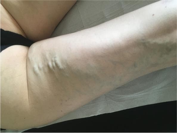 This clinical photograph shows a prone view of a patient’s posterior thigh, highlighting an atypical distribution of varicose veins. The image demonstrates prominent, dilated, and tortuous subcutaneous veins located primarily on the posterior aspect of the upper thigh. These varices exhibit characteristic bulging morphology and a bluish-purple discoloration beneath the skin surface. Unlike common lower extremity varicosities associated with saphenous vein reflux, this specific posterior thigh pattern is a key clinical sign that should raise diagnostic suspicion for a pelvic venous source, such as pelvic congestion syndrome or nutcracker syndrome. The visual evidence emphasizes the importance of a thorough physical examination and the use of cross-sectional imaging (CT or MR venography) to evaluate for proximal venous obstruction or reflux in patients presenting with such atypical venous patterns.