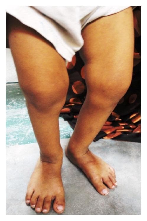 A clinical photograph of the lower extremities of a pediatric patient exhibiting signs of metabolic bone disease, likely rickets. The image demonstrates a prominent bilateral bowing of the legs (genu varum), characterized by a distinct outward curvature of the femoral and tibial shafts. There is marked enlargement and widening of the ankle joints, consistent with metaphyseal flaring. The skin over the affected regions appears intact without discoloration or acute inflammatory changes. This presentation is a classic clinical manifestation of vitamin D deficiency or hereditary rickets, illustrating the skeletal deformities that arise from impaired mineralization of the growth plates and osteoid matrix during development. The image serves as an educational tool for identifying physical signs of systemic pediatric bone pathology and understanding the orthopedic consequences of chronic mineral deficiencies.