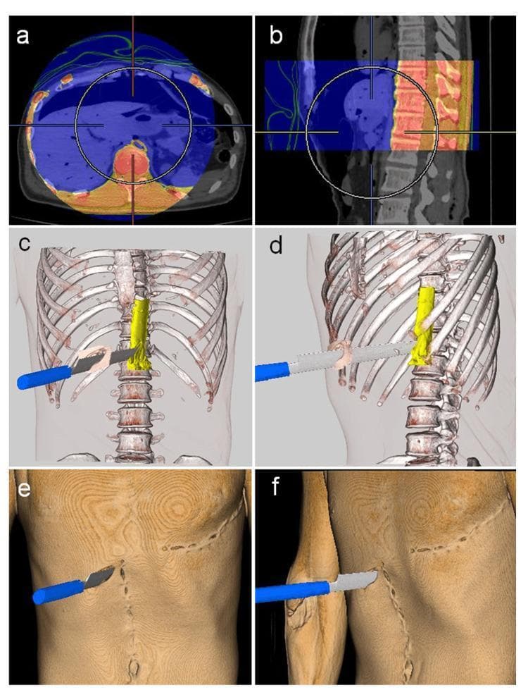 This composite image illustrates the use of post-mortem computed tomography (PMCT) and 3D volume rendering for forensic reconstruction of a fatal stab wound. Panels A and B show 2D axial and sagittal CT views, respectively, using a pseudocolor overlay to align pre-autopsy and intra-autopsy data at the level of the T11-T12 vertebrae. Panels C and D provide 3D volume-rendered reconstructions with transparent skin, highlighting the skeletal structures in white and the abdominal aorta in yellow. A digital model of the weapon (a knife) is superimposed, demonstrating its trajectory through the right hypochondriac region and its direct impact on the ruptured aorta anterior to the first lumbar vertebra. Panels E and F show the external 3D surface rendering with brown skin tones, depicting the entry site of the knife in the right hypochondrium, along with surgical markers of resuscitation, including a midline laparotomy scar and a left-sided thoracotomy scar. This visualization aids in defining the wound path and explaining the mechanism of exsanguination.
