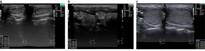 This diagnostic image displays three B-mode ultrasound panels illustrating different types of malignant thyroid nodules in the right lobe, categorized by the EU TI-RADS system. Panel (a) shows Medullary Thyroid Carcinoma (MTC) presenting as a nodule with mixed echogenicity, irregular contours, and internal microcalcifications. Panel (b) depicts Papillary Thyroid Carcinoma (PTC) characterized by an ill-defined, hypoechoic, and heterogeneous structure with scattered echogenic foci suggestive of microcalcifications. Panel (c) illustrates Follicular Thyroid Carcinoma (FTC), which appears as a relatively homogeneous, well-circumscribed nodule with a smooth contour, lacking obvious macrocalcifications. Each panel includes transverse and longitudinal views with calipers measuring nodule dimensions (d1, d2, d3) and calculated volume. These sonographic findings demonstrate key diagnostic features used to differentiate follicular and parafollicular thyroid malignancies, specifically focusing on echogenicity, border definition, and the presence of calcifications.