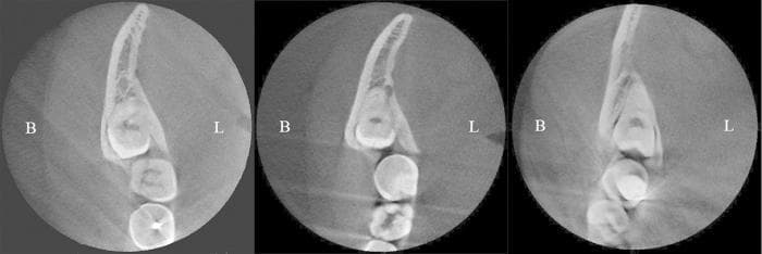 This diagnostic image consists of three parallel Cone Beam Computed Tomography (CBCT) cross-sections of the mandible, demonstrating the classification of an impacted third molar's position relative to the buccal and lingual alveolar bone plates. The sections are labeled B (buccal) and L (lingual) for anatomical orientation. Case (A) shows a buccal position, where the third molar is shifted toward the buccal plate, resulting in a significantly thinner buccal alveolar wall compared to the lingual side. Case (B) illustrates a central position, with the tooth situated equidistant between both cortical plates, showing relatively uniform bone thickness on both aspects. Case (C) demonstrates a lingual position, where the tooth is positioned closer to the lingual cortex, resulting in a thinning of the lingual bone plate. This visual comparison is used in dental medicine and oral surgery for preoperative assessment, risk evaluation of lingual nerve injury, and determining the appropriate surgical approach for extraction based on cortical bone density and thickness.