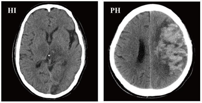 This diagnostic image consists of two axial non-contrast CT scans of the brain demonstrating hemorrhagic transformation (HT) in acute ischemic stroke, categorized according to the ECASS II classification. The first scan, labeled 'HI' (Hemorrhagic Infarction), shows subtle, ill-defined areas of hypodensity within the cerebral parenchyma, particularly in the right hemisphere, suggesting petechial hemorrhage or small areas of bleeding within an infarcted zone without a significant space-occupying effect. The second scan, labeled 'PH' (Parenchymal Hemorrhage), displays a prominent, heterogeneous hyperdense region in the left cerebral hemisphere indicative of acute blood. This lesion involves multiple lobes (frontal and parietal) and exhibits significant mass effect, including compression of the ipsilateral lateral ventricle and a rightward midline shift. These images serve as educational examples for differentiating types of hemorrhagic complications after stroke, highlighting the visual distinction between scattered petechiae (HI) and confluent hematoma (PH).