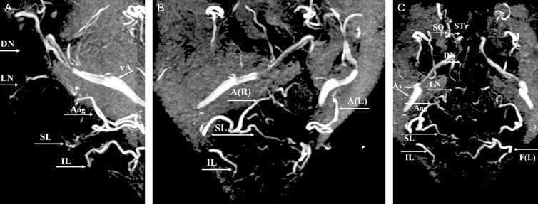 Diagnostic diagnostic imaging showing the arterial anatomy of the human face via 3D Magnetic Resonance Angiography (MRA) with Maximum Intensity Projection (MIP) reconstructions. The image comprises three views: (A) Lateral, (B) Right oblique, and (C) Anteroposterior (AP). Key vascular structures are labeled to demonstrate the course and branching patterns of the facial arterial system. The facial artery (F) is seen giving rise to the inferior labial (IL) and superior labial (SL) arteries before continuing superiorly as the angular artery (Ang/A). Distal branches including the lateral nasal (LN), dorsal nasal (DN), supratrochlear (STr), and supraorbital (SO) arteries are identified, illustrating the complex terminal arborization around the nose and orbits. Additionally, the angular vein (vA/Av) is visible, providing a clinical comparison between arterial and venous calibers in the midface. This imaging is highly relevant for plastic surgery, dermatology, and maxillofacial surgery planning, particularly for understanding vascular danger zones during aesthetic filler injections or reconstructive procedures.