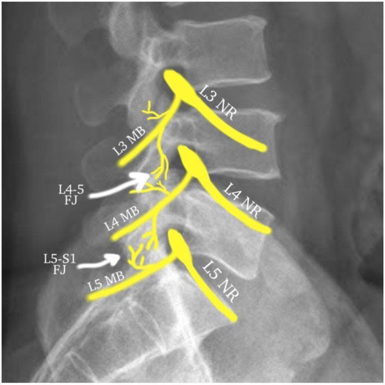 This lateral lumbar spine X-ray contains an anatomical overlay diagram illustrating the dual innervation of lumbar facet joints (zygapophyseal joints). The visual focuses on the L3, L4, and L5 nerve levels. The L4-L5 facet joint (L4-5 FJ) is shown receiving innervation from the L3 and L4 medial branches (MB), which originate from their respective nerve roots (NR). The L5-S1 facet joint (L5-S1 FJ) is shown being innervated by the L4 medial branch and the L5 dorsal ramus/medial branch. Yellow graphic overlays map the pathway of these nerves as they exit the neural foramina and descend over the transverse processes to supply the joints. The image serves as an educational guide for interventional pain management, specifically for identifying targets in medial branch blocks or radiofrequency ablation (RFA) to treat chronic low back pain originating from facet arthropathy.
