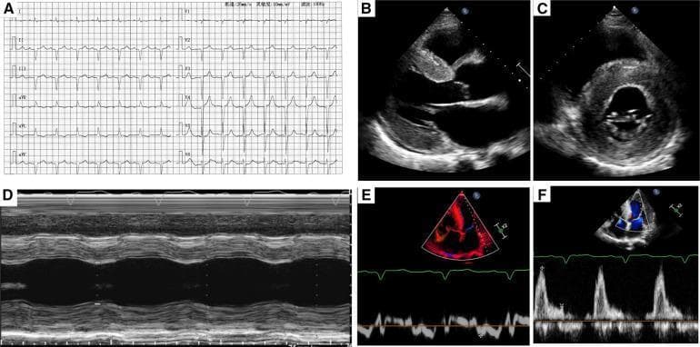 This composite image illustrates diagnostic findings for a patient with restrictive cardiomyopathy, specifically cardiac amyloidosis. Panel A shows a 12-lead electrocardiogram (ECG) with low-voltage QRS complexes and signs of prior myocardial infarction. Panels B and C are two-dimensional transthoracic echocardiograms (parasternal long-axis and short-axis views) showing severe concentric left ventricular hypertrophy and a characteristic 'speckled' or 'ground-glass' myocardial appearance. Panel D is an M-mode echocardiogram demonstrating reduced left ventricular contractility and wall motion abnormalities. Panels E and F provide pulse-waved and color Doppler echocardiograms showing restrictive filling patterns and flow velocity curves consistent with Stage III diastolic dysfunction. The collection highlights key imaging markers for systemic amyloidosis infiltrating the myocardium, including wall thickening, altered echogenicity, and diastolic impairment, serving as a comprehensive clinical example for cardiology education.