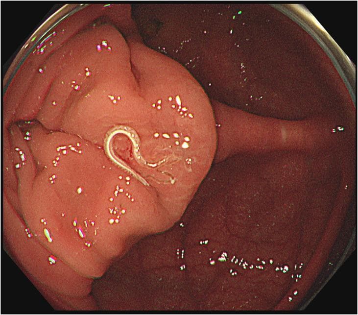 This endoscopic clinical photograph depicts a gastrointestinal parasite within the large intestine, specifically identified as a white whipworm (Trichuris trichiura) located in the cecum. The worm is characterized by a slender, elongated, and curved white body, exhibiting a characteristic whip-like morphology. It is situated on the surface of the colonic mucosa, which appears reddish-pink and healthy, though slightly nodular in texture with visible light reflections from the endoscope. The worm is positioned near the ileocecal valve area. The image demonstrates a classic presentation of trichuriasis, an intestinal nematode infection. The clinical significance of this visual is to illustrate the endoscopic detection of live helminths during colonoscopy in a patient presenting with symptoms such as chronic diarrhea and peripheral eosinophilia. The image is a valuable educational resource for gastroenterology and infectious disease specialties for the identification of parasitic infections of the human cecum and ascending colon.