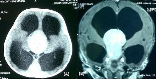 This diagnostic imaging comparison consists of two axial brain scans from a 4-month-old infant: (A) a non-contrast computed tomography (CT) scan and (B) a contrast-enhanced T1-weighted magnetic resonance image (MRI). Both modalities reveal a large, well-defined mass located in the suprachiasmatic region with superior extension into the third ventricle. In the CT scan, the tumor appears as a hyperdense mass relative to the surrounding brain parenchyma. The contrast-enhanced MRI demonstrates intense, homogenous enhancement of the lesion, suggesting a highly vascular or blood-brain barrier-disrupted tumor such as an optico-chiasmatic glioma. Significant secondary features include massive obstructive hydrocephalus, evidenced by the severe symmetrical dilatation of the lateral ventricles (appearing as large hypodense areas on CT and dark signal on T1 MRI). The imaging illustrates the utility of MRI over CT for superior soft-tissue contrast and anatomical delineation of midline pediatric brain tumors and their relationship to the ventricular system.