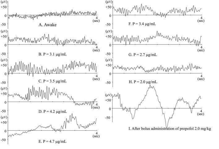 A multi-panel series of raw electroencephalogram (EEG) tracings illustrating changes in brainwave morphology during propofol anesthesia induction, maintenance, and recovery. Panels A–E demonstrate the progression from an 'Awake' state—characterized by low-amplitude, high-frequency activity—to deep anesthesia at increasing effect-site concentrations (P) ranging from 3.1 to 4.7 µg/mL. As concentration increases, the EEG shows a clear transition from fast beta/gamma activity to high-amplitude alpha spindles (Panel C) and finally to dominant slow-wave theta and delta activity with emerging burst-suppression features (Panel E). Panels F–H show the symmetrical reversal of these patterns during recovery as propofol concentration decreases. Panel I highlights a specific clinical scenario: the immediate post-bolus state (2.0 mg/kg), which displays distinct high-amplitude delta waves and significant frequency slowing, often correlating with low Bispectral Index (BIS) values. The Y-axis for all tracings measures voltage in microvolts (µV) from -50 to +50, and the X-axis represents a 4-second time interval. This educational visual demonstrates the dose-dependent neurophysiological effects of intravenous anesthetics on cortical electrical activity.