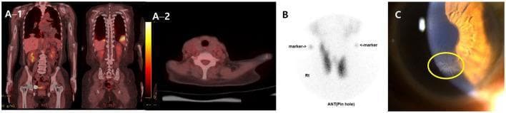 This composite educational image illustrates multi-organ manifestations of amiodarone toxicity through diagnostic imaging and clinical photography. Panel A shows FDG PET-CT scans: the whole-body coronal view (A-1) displays multiple hypermetabolic lesions throughout the lung fields, while the axial thyroid view (A-2) shows no abnormal tracer uptake. Panel B presents a technetium-99m pertechnetate thyroid scintigraphy scan, demonstrating diffuse, homogenous tracer uptake in both lobes, characteristic of type 1 amiodarone-induced thyrotoxicosis in the context of Graves' disease. Panel C is a slit-lamp biomicroscopy photograph of the cornea, highlighting 'vortex keratopathy' (cornea verticillata). A yellow circle denotes the characteristic dense, gray granular lines forming a swirling, vortex-like pattern radiating from the inferior corneal region. Together, these images demonstrate the systemic impact of amiodarone, including pulmonary toxicity (hypermetabolic lung lesions), thyroid dysfunction, and ocular side effects (corneal deposits).