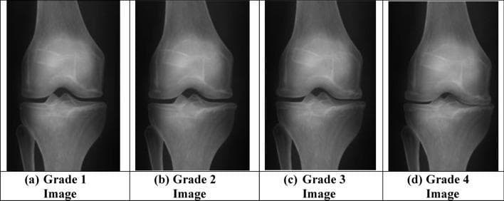 This diagnostic comparison chart displays four anteroposterior (AP) radiographic views of the human knee joint, illustrating the progression of knee osteoarthritis according to Kellgren–Lawrence (KL) grading. The images, labeled (a) through (d), represent Grade 1 to Grade 4 of the disease. In Grade 1 (a), the joint space appears largely preserved with minimal radiographic changes. As the progression moves toward Grade 4 (d), there is a clear chronological worsening of pathological features. Key diagnostic signs demonstrated include progressive joint space narrowing (JSN), particularly in the medial compartment, and the development of osteophytes (bone spurs) along the joint margins. Advanced stages, specifically Grade 3 and Grade 4, exhibit more severe narrowing, subchondral sclerosis (increased bone density appearing as whiter areas on the X-ray), and potential subchondral cysts or bone contour irregularities. This visual is intended for orthopedic and radiological education to assist in the classification and early detection of osteoarthritis using deep learning models (GAO-DCNN).
