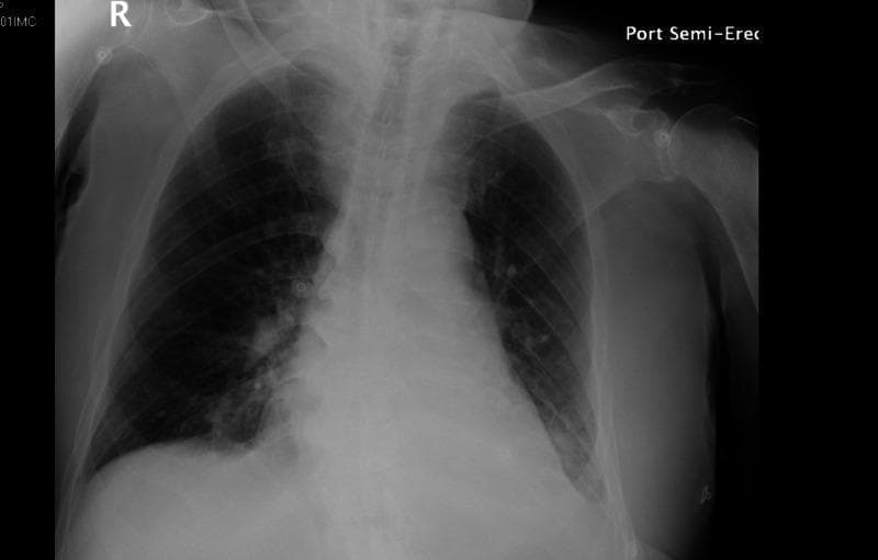 A portable semi-erect (Port Semi-Erect) frontal chest X-ray demonstrating multiple thoracic abnormalities. The cardiac silhouette is markedly enlarged, consistent with cardiomegaly. Evaluation of the pulmonary parenchyma reveals bilateral heterogeneous opacities, primarily concentrated in the bibasilar regions, suggesting airspace disease or infiltrates. In the pleural spaces, the right costophrenic angle remains relatively sharp, whereas the left costophrenic angle is blunted and obscured by an area of increased density along the left lateral chest wall, indicative of a small left pleural effusion. The pulmonary vasculature appears prominent, which, in the context of cardiomegaly, may represent pulmonary vascular congestion. These findings are characteristic of multifocal pneumonia, potentially superimposed on congestive heart failure. External artifacts, such as ECG leads, are visible on the chest wall.