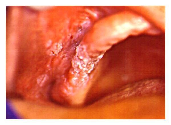 This clinical intraoral photograph displays a prominent, exophytic white lesion with a classic verrucous (wart-like) texture. The lesion is primarily localized to the molar region of the right maxillary alveolar ridge. It exhibits a distinctive cauliflower-like or papillary surface morphology and extends beyond the gingival tissues to involve the adjacent buccal vestibule and the mucosal lining of the inner cheek. The overall appearance is characterized by thick, hyperkeratotic white plaques that are confluent and well-demarcated from the surrounding erythematous oral mucosa. This visual presentation is highly characteristic of verrucous carcinoma, a low-grade variant of squamous cell carcinoma. The image serves as an educational example of oral oncology, highlighting the clinical features of proliferative epithelial lesions in the oral cavity for dental and medical students.