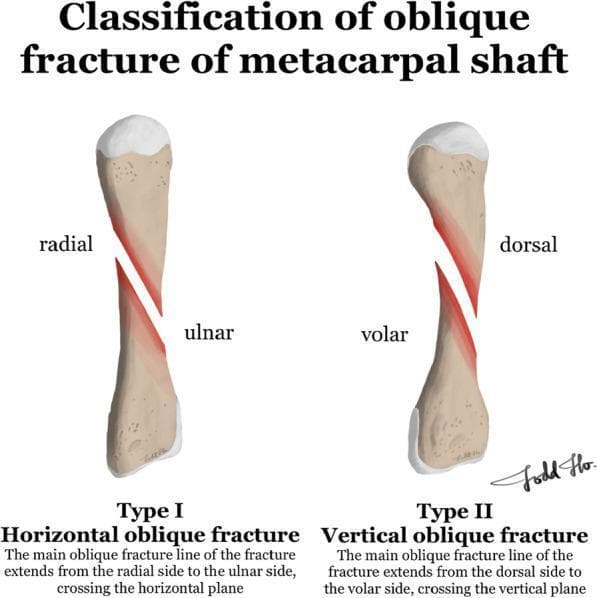 This medical illustration presents a classification system for oblique metacarpal shaft fractures, categorized into two types based on the orientation of the fracture line relative to anatomical planes.
Type I, labeled as a 'Horizontal oblique fracture,' depicts the fracture line extending diagonally from the radial side to the ulnar side, effectively crossing the horizontal (coronal) plane of the metacarpal shaft.
Type II, labeled as a 'Vertical oblique fracture,' illustrates the fracture line extending from the dorsal side to the volar side, crossing the vertical (sagittal) plane of the bone.
The diagram uses labeled anatomical markers ('radial', 'ulnar', 'dorsal', 'volar') to orient the viewer and highlights the fracture surfaces in red to emphasize the morphology of the break. This comparison chart is an educational tool for orthopedic surgery and hand trauma, demonstrating how fracture orientation influences anatomical disruption and potentially dictates surgical fixation strategies, such as the placement of lag screws or dorsal plates.