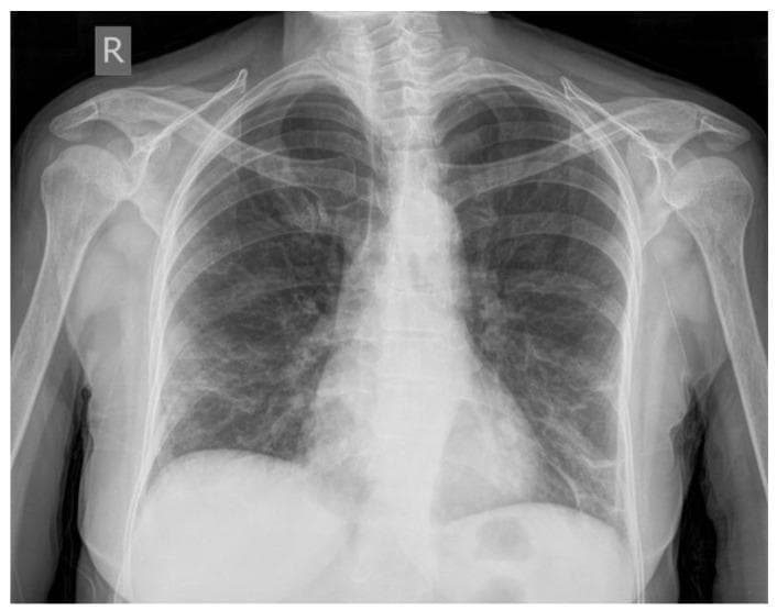 This anterior-posterior (AP) chest X-ray illustrates typical radiological findings of bilateral COVID-19 pneumonia. The primary pathology consists of diffuse 'ground-glass opacities' and areas of consolidation distributed throughout the lung fields. The infiltrates are predominantly located in the lower lobes and peripheral/subpleural regions of both the left and right lungs. Reticulonodular changes and interstitial infiltrative patterns are visible, especially within the areas of consolidation in the basal regions. The cardiac silhouette and mediastinal contours appear within normal limits, while the diaphragmatic domes are distinct. The presence of these confluent, bilateral lower lung opacities is highly characteristic of acute viral pneumonia, such as that caused by SARS-CoV-2. This diagnostic image serves as a clinical example of early-stage hospitalization findings in patients with extensive pulmonary involvement.