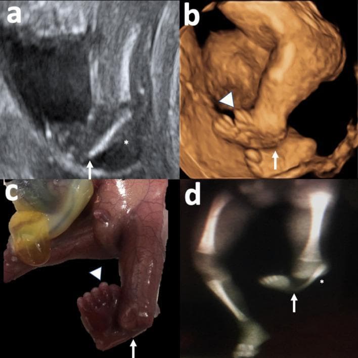 A multi-panel medical image illustrating congenital lower limb malformations across different imaging modalities and specimens. Panel (a) is a 2D grayscale ultrasound of a fetal leg showing a hypoplastic fibula (*) and clubfoot (arrow). Panel (b) depicts a 3D ultrasound reconstruction of the same limb, highlighting the inverted position of the clubfoot and pre-axial polydactyly (arrowhead). Panel (c) provides a clinical photograph of the post-mortem fetal specimen, clearly showing the supernumerary digits of the pre-axial polydactyly and the severe equinovarus deformity (clubfoot). Panel (d) shows a postnatal X-ray of the lower limbs; the left leg demonstrates a hypoplastic, shortened fibula and abnormal bony alignment of the foot consistent with clubfoot, while the right leg displays a normal tibia and fibula. The collective findings demonstrate tibial hemimelia and associated distal limb defects including polydactyly and talipes equinovarus, serving as a comparative educational resource for prenatal diagnosis and pathological correlation.