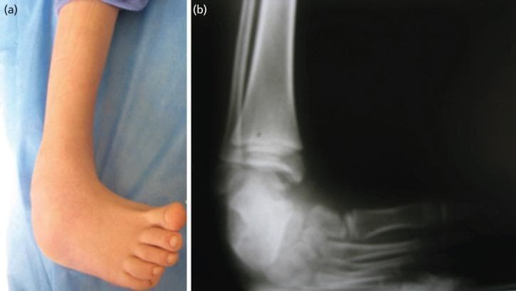 This composite educational resource consists of a clinical photograph and a corresponding diagnostic radiograph of a pediatric foot and ankle, illustrating congenital talipes equinovarus, commonly known as clubfoot. Panel (a) is a clinical photograph showing the characteristic morphology of the deformity, including severe equinus (plantarflexion), hindfoot varus (inversion of the heel), and forefoot adduction with the sole facing medially. Panel (b) is an anteroposterior X-ray demonstrating the underlying skeletal malalignment. Key radiological findings include the abnormal parallel relationship between the long axes of the talus and calcaneus (reduced talocalcaneal angle), marked plantarflexion of the talus relative to the tibia, and medial deviation of the metatarsals. These images serve as a teaching tool for orthopedic residents to recognize the 'CAVE' components of clubfoot: cavus, adductus, varus, and equinus. The materials are relevant for preoperative assessment in pediatric orthopedics and illustrate the degree of structural deviation requiring surgical or conservative corrective measures, such as the Ponseti method or Ilizarov external fixation.