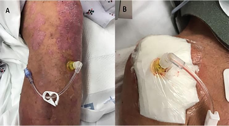 Clinical photographs of emergency intraosseous (IO) vascular access in a patient. Panel A shows a 45 mm IO needle inserted into the left proximal tibia. The surrounding skin exhibits diffuse, erythematous plaques and a scaly, textured surface, suggestive of a pre-existing dermatologic condition like psoriasis. The IO needle is connected to flexible tubing with a blue Luer-lock connector and a white plastic flow-control clamp. Panel B displays a second 45 mm IO needle inserted into the right proximal humerus. The insertion site is stabilized with a large, white absorbent dressing secured by a transparent adhesive film. Some serosanguinous drainage is visible at the needle base under the film. The image illustrates the clinical application of IO access in scenarios where intravenous stabilization is challenging, while highlighting potential complications or site-specific considerations such as underlying skin pathology or the need for securement in different anatomical locations (tibia vs. humerus).