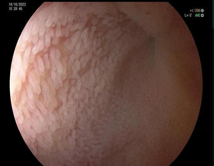 This diagnostic endoscopic image (colonoscopy) captures the terminal ileum mucosa. The visual shows a healthy, pink-colored mucosa with well-defined, elongated, pale intestinal villi characteristic of normal small bowel anatomy. There is no evidence of inflammation, ulceration, erythema, or visible lesions. Notably, the ileal lumen appears collapsed or significantly narrowed at the distal aspect shown, which in this clinical context signifies a complete luminal obstruction approximately 10 cm proximal to the ileocecal valve. The diagnostic focus is the contrast between the unremarkable, healthy appearance of the mucosal surface and the mechanical obstruction of the lumen. This image is relevant for gastroenterology and general surgery education, illustrating that mechanical small bowel obstructions (such as those caused by extrinsic adhesive bands or volvulus) may present with normal intraluminal mucosal findings despite severe clinical obstruction.