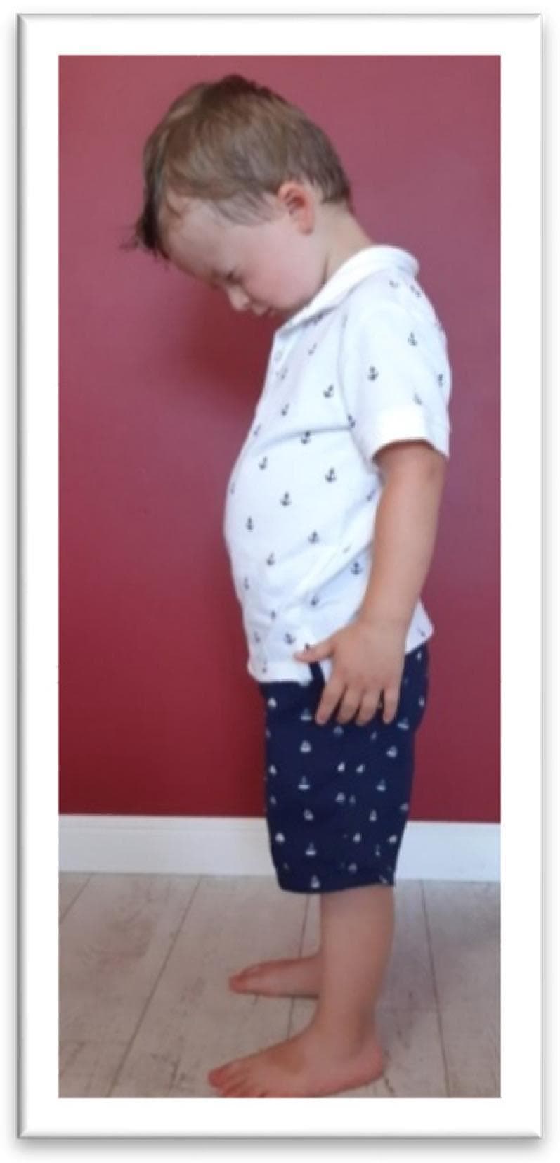 A clinical photograph depicting a pediatric patient in a standing position, demonstrating the assessment for a retained Tonic Labyrinthine Reflex in flexion (TLR FLX). The image illustrates characteristic compensatory motor responses when the child is asked to look downward. Visible findings include significant forward flexion of the head (neck flexion), a rounded or slumped spinal posture (thoracic kyphosis), and slight knee flexion (deflection) rather than maintaining a neutral upright stance. This visual is used in developmental pediatrics and physical therapy to identify primitive reflex persistence, which can impact postural control and motor coordination in preschoolers. The child is viewed from a lateral profile to highlight the sagittal plane deviations of the head, trunk, and lower extremities.