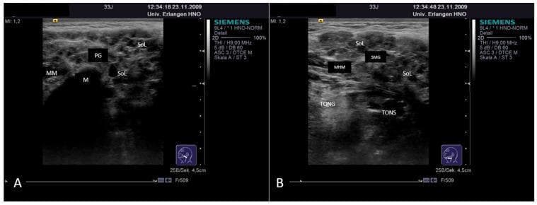 This diagnostic image displays two grayscale ultrasound frames (A and B) showing advanced-stage Sjögren's Syndrome in the major salivary glands. Panel A depicts the left parotid gland (PG), characterized by a markedly heterogeneous parenchyma. The normal glandular echotexture is replaced by numerous hypoechoic to anechoic spot-like formations and larger space-occupying lesions (SoL), representing lymphocytic infiltration or sialectatic ducts. Anatomical landmarks include the masseter muscle (MM) and the mandible (M), which presents with a sharp acoustic shadow. Panel B illustrates the left submandibular gland (SMG), showing similar diffuse heterogeneity and parenchymal rarefaction with multiple internal anechoic spots. Surrounding structures identified include the mylohyoid muscle (MHM) located superiorly, the tongue (TONG), and the tonsillar region (TONS). Both glands demonstrate pathologic enlargement. This image serves as a clinical example of chronic autoimmune sialadenitis where secretory tissue is progressively replaced by cystic and solid inflammatory changes.