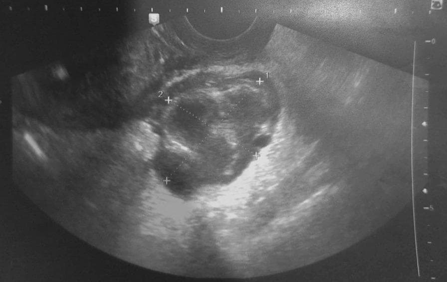 A transvaginal grey-scale ultrasound image demonstrating a complex adnexal mass, approximately 6 cm in diameter, located in the juxta-uterine region. The mass is primarily cystic with irregular, thickened walls and heterogeneous internal echogenicity, suggesting the presence of debris, pus, or complex fluid. A characteristic 'cogwheel sign' is visible, represented by thickened endosalpingeal folds that project into the lumen of the dilated fallopian tube, which is a classic sonographic indicator of pyosalpinx. The morphology is tubular and tortuous rather than purely spherical, typical of pelvic inflammatory disease progression. Caliper markers are placed to measure the dimensions of the collection. The surrounding stroma shows increased echogenicity, consistent with inflammatory changes in the adnexa. This diagnostic image illustrates the sonographic features used to differentiate pyosalpinx from other adnexal masses like ovarian cysts or ectopic pregnancies.