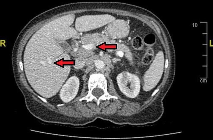 This diagnostic image is a contrast-enhanced axial (transverse) computed tomography (CT) scan of the upper abdomen. The visualization shows a cross-section of the abdominal cavity with anatomical landmarks including the liver (right), pancreas (central), kidneys (bilateral posterior), and the vertebral body of the spine. Red arrows highlight significant clinical findings: one arrow indicates a hyperenhancing mass located within the pancreatic head, identified as a primary gastrinoma (Zollinger-Ellison syndrome). A second arrow identifies a focal lesion within the hepatic parenchyma, consistent with metastatic disease. The image demonstrates the relationship between primary neuroendocrine tumors and their secondary spread. The surrounding soft tissues, retroperitoneal space, and bowel loops are also visible, providing context for tumor localization and staging. This visual is intended for medical education regarding the diagnostic imaging of pancreatic neuroendocrine tumors and their common metastatic patterns to the liver.