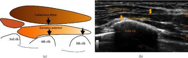 This educational graphic illustrates the ultrasound-guided serratus plane block technique through two side-by-side panels. Panel (a) is a simplified anatomical diagram showing the spatial relationship between thoracic muscles and ribs. The latissimus dorsi is depicted superficially over the serratus anterior muscle, which rests atop the 3rd, 4th, and 5th ribs. Panel (b) is a corresponding ultrasound image in the transverse plane at the axillary region. It identifies key landmarks including the latissimus dorsi, serratus anterior, and the hyperechoic surface of the fifth rib with an acoustic shadow below it. Yellow arrows in both panels indicate the primary targets for local anesthetic infiltration: the interfascial plane between the latissimus dorsi and serratus anterior, and the space deep to the serratus anterior muscle. The visual is designed to teach regional anesthesia residents and clinicians the correct needle placement for blocking the intercostobrachial and lateral intercostal nerves (T3-T9) for thoracic wall analgesia.