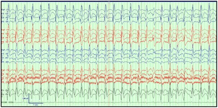This diagnostic image displays a continuous electroencephalogram (EEG) tracing from a 52-year-old female patient, demonstrating Generalized Periodic Discharges (GPDs) with a classic triphasic morphology. The recording is presented in a longitudinal bipolar montage (10-20 system), showing activity across frontal, central, parietal, temporal, and occipital regions. The prominent triphasic waves occur at a frequency of approximately 1-2 Hz and are characterized by three phases: a low-amplitude negative deflection, a subsequent larger positive phase, and a high-amplitude negative terminal phase. A noticeable posterior-to-anterior gradient is present. The underlying background activity consists of diffuse, irregular delta and theta waves, indicative of encephalopathy. In this clinical context, these findings are consistent with toxic-metabolic encephalopathy, specifically associated here with chronic kidney disease, sepsis, and cefepime administration. Technical parameters include a low-frequency filter of 1 Hz, a high-frequency filter of 70 Hz, and a sensitivity of 7 μV/mm.